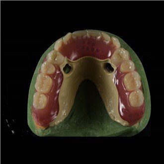 Peek Framework Dentadura