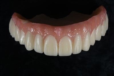 Corona temporal de resina acrílica